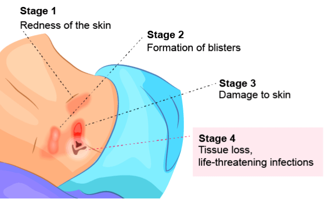 Illustration of pressure ulcers for stages 1 - 4 with life-threatening infections at stage 4 bedsore.