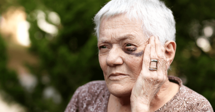 an older woman with a black eye