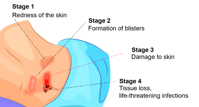 Image above shows the different stages of bedsores.