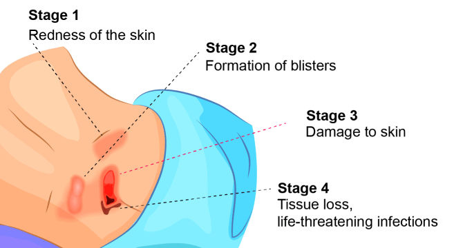 How to Prevent Pressure Sores in Bedridden Patients at Home, Zenesse  Health