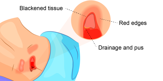 A graphic showing the symptoms of stage 3 bedsores. Common symptoms include blackened tissue, red edges, drainage, and pus.