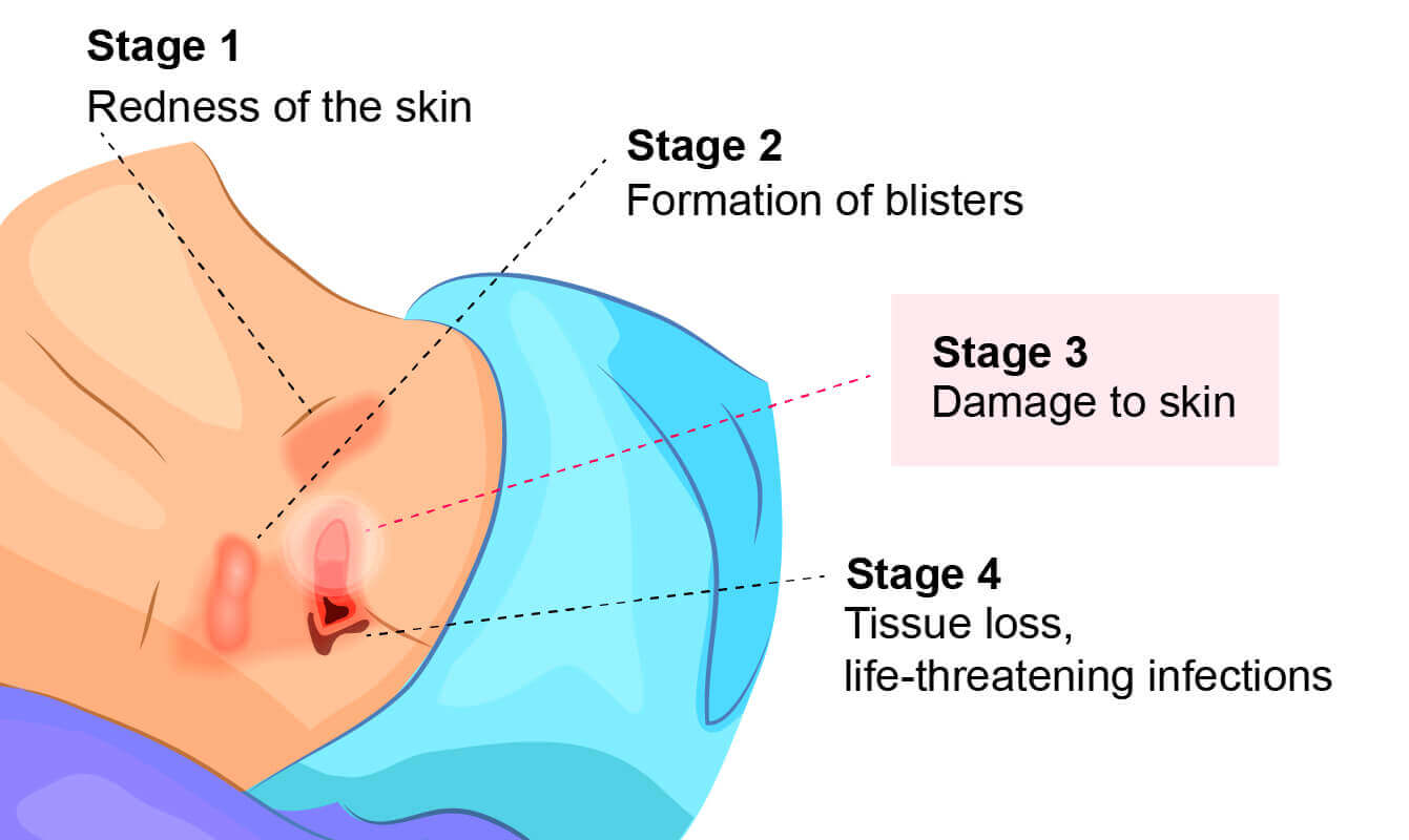 A graphic showing the four stages of bedsores. Stage 3 bedsores cause severe damage to the skin.